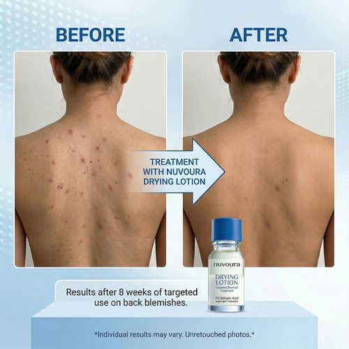 Nuvoura Blemish Drying Lotion